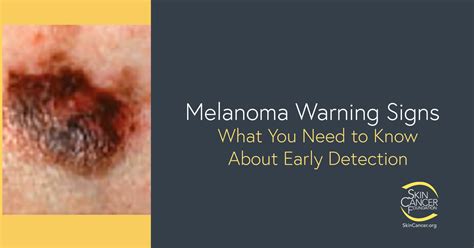 early signs of melanoma skin cancer